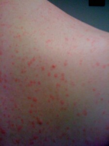 Cholinergic Urticaria Back Shoulder Cholinergic Urticaria, hives on shoulder, cholinergic urticaria bumps