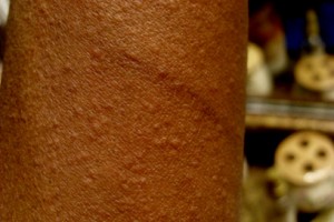 Cholinergic urticaria Cholinergic Urticaria Image