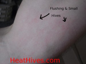 Heat Hives Cholinergic Urticaria on arm