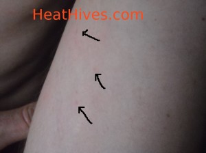 cholinergic urticaria hives pictures