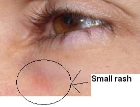 rash on face, rash under eye, itchy spot under eye