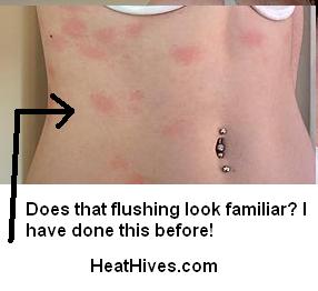aquatic urticaria reaction, aquagenic hives, water allergy, hives caused by water