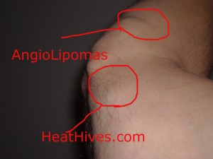 angiolipomas, tumor in arm, lipoma in bicep, tricep, forearm, hives, cholinergic urtcaria