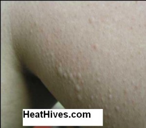 cold urticaria hives