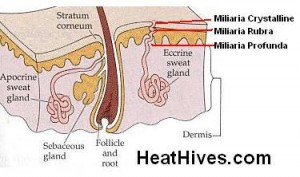 sweat glands, hair folicule, oil gland, cholinergic urticaria, diagram, miliaria