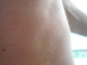 UVB treatment, chronic hives, cholinergic urticaria, hives on torso,